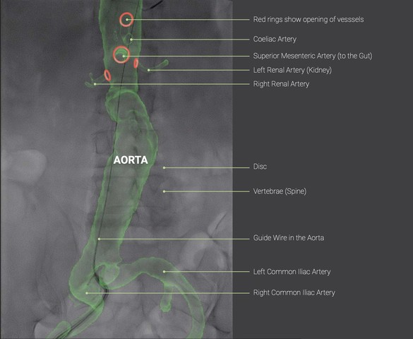 An example overlay, left. We later changed to an outline after realising a noisy 3D image over a noisy 2D image was a bad idea